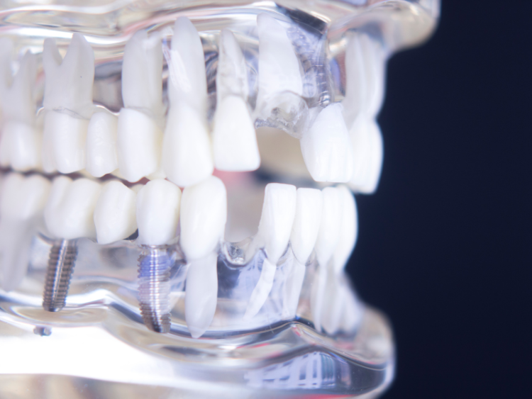 Dental Implant Surgery in Noblesville, IN